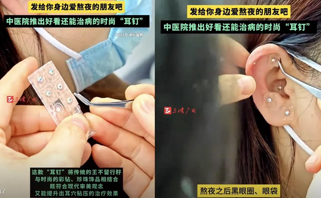 穴贴钻疗法爆红日本！中医华丽变身时尚单品- 医馆界-中医行业的良心和大脑